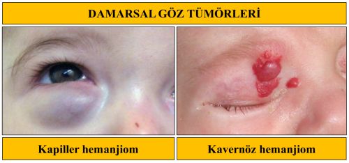 damarsal-tumor