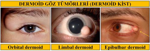 Cocukluk Cagi Goz Tumorleri Ve Retinoblastoma Cocuklu Dunya