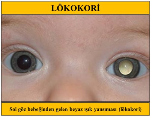 Cocukluk Cagi Goz Tumorleri Ve Retinoblastoma Cocuklu Dunya