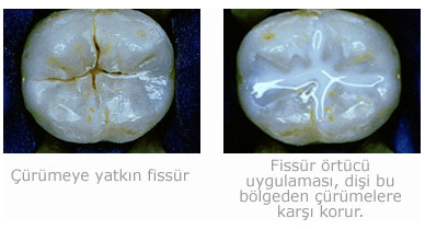 Fissür Örtücü (Fissur Sealant) ile Diş Çürükleri Nasıl Engellenir?