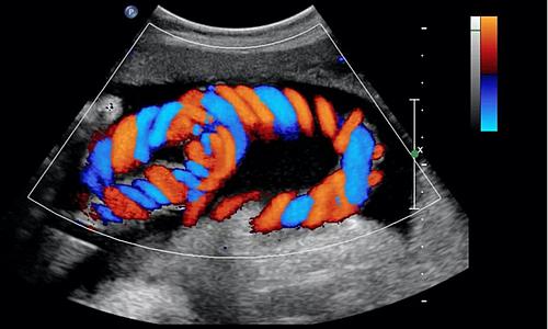 Renkli Doppler Ultrasonografi Hakkında Merak Ettikleriniz